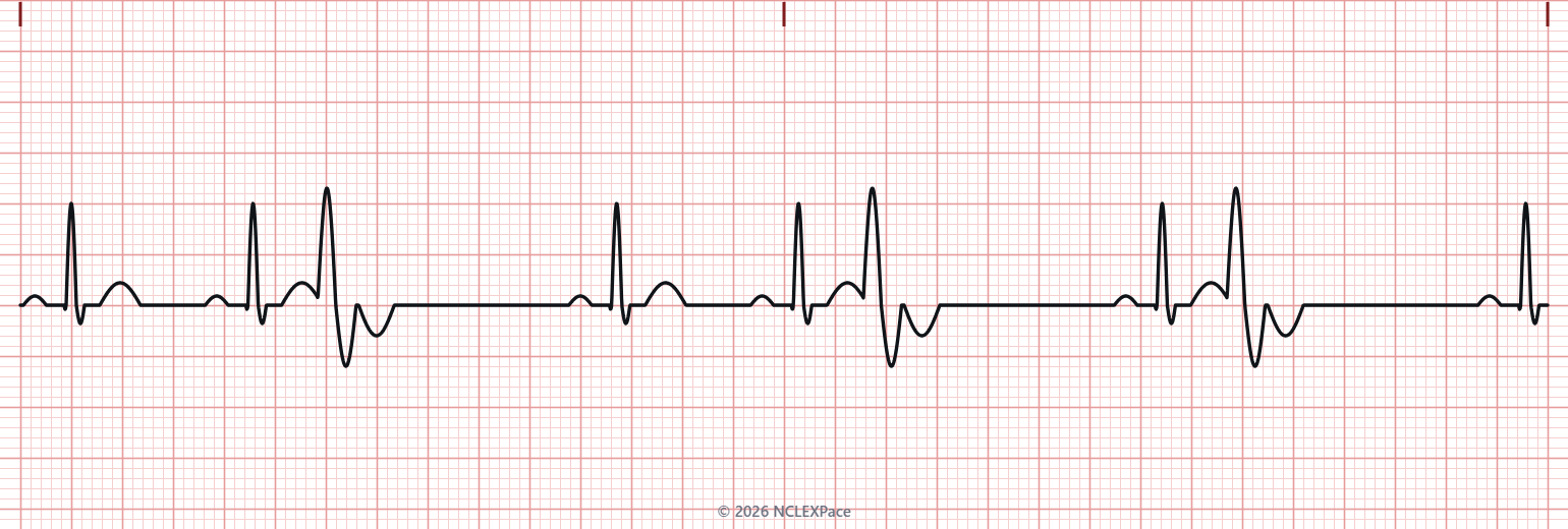 Cardiac monitor rhythm strip
